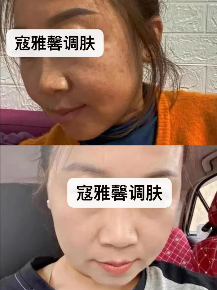 记者探秘:寇雅馨护肤品有依赖性吗，祛斑效果好不好